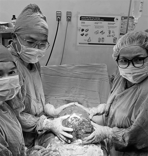 Hình ảnh ekip ca phẫu thuật lấy thai song hành cắt bỏ khối u xơ nặng 6,2kg cho sản phụ