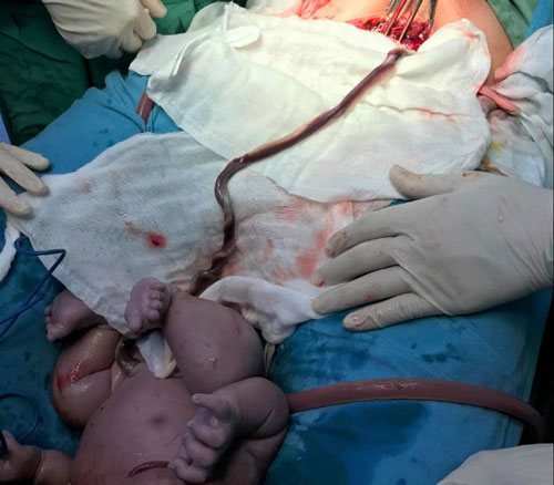 Theo các bác sĩ, em bé khi mổ bắt ra, quan sát thấy tắc gần toàn bộ dây rốn.