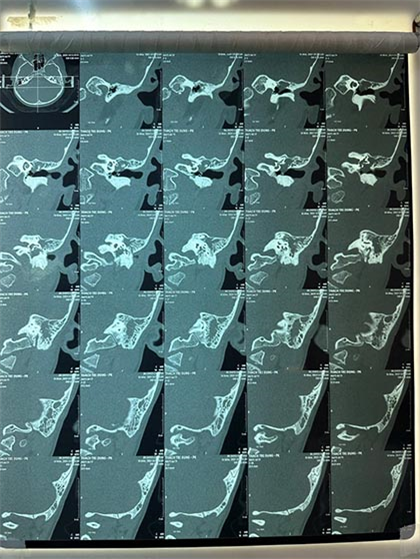 Hình ảnh chụp cắt lớp vi tính: Cholesteatoma xâm lấn hòm nhĩ, xương chũm
