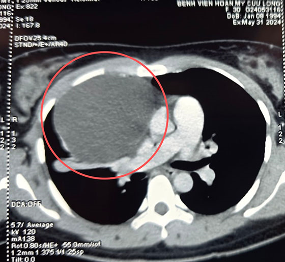 Hình ảnh khối u trung thất khi chụp MSCT